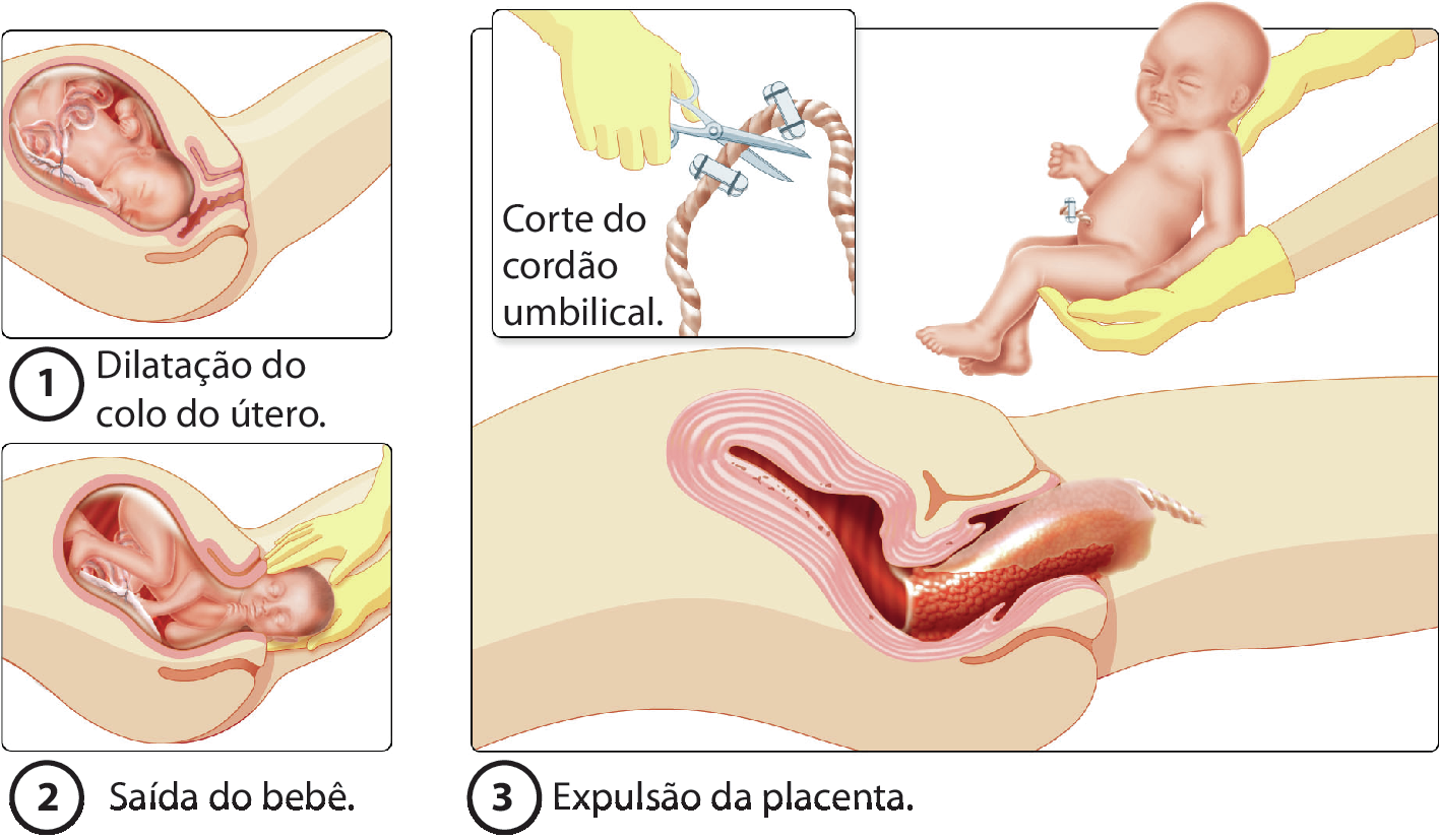 Ilustração de um parto normal. Ilustração dividida em três etapas. Etapa 1. Ilustração do feto no útero, onde há o aumento do local por onde o bebê sairá. Há o texto: Dilatação do colo do útero. Etapa 2. Ilustração do feto com a cabeça para fora e o corpo ainda dentro do útero. Há duas mãos apoiando a cabeça do bebê. Há o texto: Saída do bebê. 3. A ilustração mostra a placenta, órgão avermelhado. Acima, destaque para o corte do cordão umbilical, com uma mão segurando uma tesoura sobre o cordão umbilical, que tem dois prendedores ao lado de onde o corte será feito. Ao lado, duas mãos segurando o bebê que está com um prendedor no umbigo. Há o texto: Expulsão da placenta.