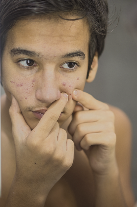 Fotografia. Homem branco espremendo com as duas mãos uma espinha no rosto.