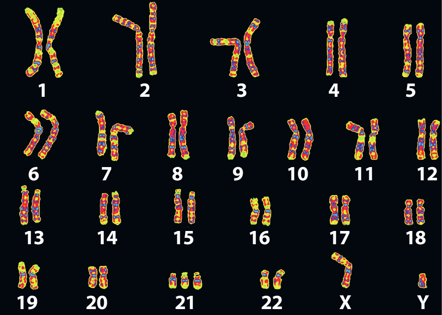 Fotomicrografia. Sobre fundo preto, 23 pares de cromossomos, com 3 ocorrências do cromossomo 21. Alguns são mais compridos em relação a outros. No canto inferior, cromossomo X e cromossomo Y.