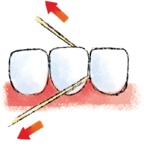 Imagem: Ilustração. Fio dental entre dois dentes. Na parte inferior, gengiva de cor vermelha. Duas setas vermelhas com sentidos opostos. Fim da imagem.