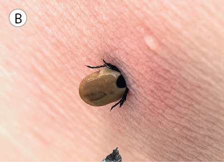 Imagem: Fotografia B. Sobre pele de pessoa clara, um carrapato arredondado de cor marrom com patas finas em preto. Texto : Comprimento: 4 mm. Fim da imagem.