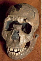Imagem: Fotografia de um crânio com dentes. Na parte superior há uma rachadura e um buraco. Fim da imagem.