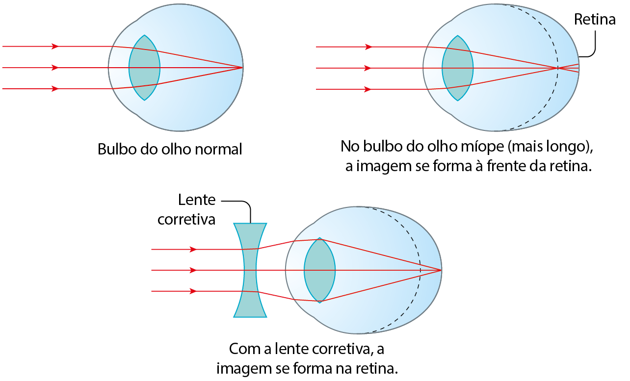 Esquema. Três setas paralelas para a direita, na direção do bulbo de um olho normal. As linhas entram no olho e convergem até um ponto no fundo do olho.
Esquema. Três setas paralelas para a direita, na direção de um globo ocular. As linhas entram no olho, se cruzam em uma linha tracejada que demarca o formato de um olho normal e vão até a retina, no fundo do olho. No bulbo do olho míope (mais longo), a imagem se forma à frente da retina.
Esquema. Três setas paralelas para a direita, na direção do bulbo de um olho míope. As linhas passam por uma lente corretiva, que afasta as mais externas, entram no olho e convergem até um ponto no fundo do olho. Com a lente corretiva, a imagem se forma na retina.