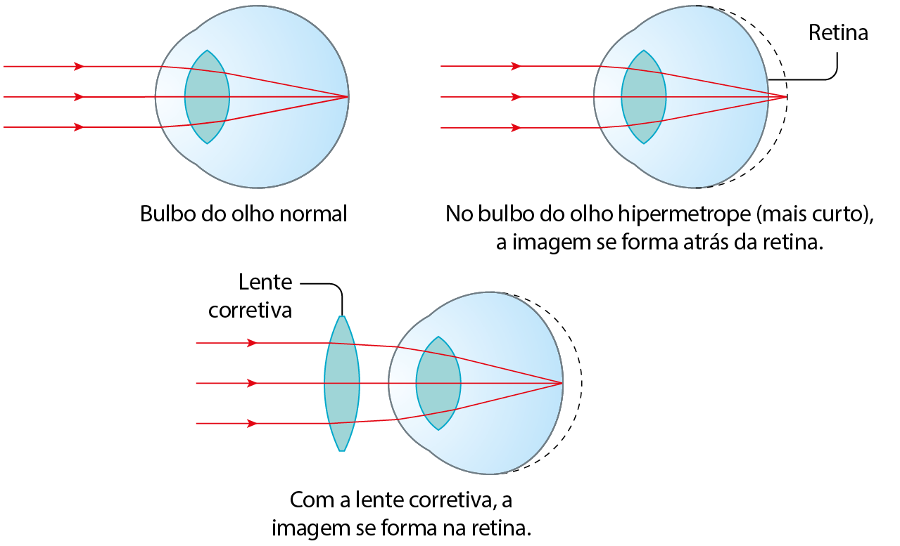 Esquema. Três setas paralelas para a direita, na direção do bulbo de um olho normal. As linhas entram no olho e convergem até um ponto no fundo do olho.
Esquema. Três setas paralelas para a direita, na direção de um globo ocular. As linhas entram no olho e convergem em uma linha tracejada após o fundo do olho que demarca o tamanho do olho normal. No bulbo do olho hipermetrope (mais curto), a imagem se forma atrás da retina.
Esquema. Três setas paralelas para a direita, na direção de um globo ocular hipermetrope. As linhas passam por uma lente corretiva que aproximam as mais externas, entram no olho e convergem até um ponto no fundo do olho. Com a lente corretiva, a imagem se forma na retina.