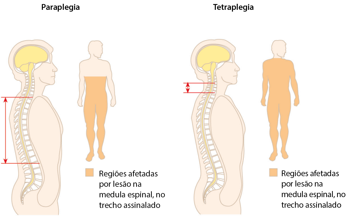 Ilustração. Paraplegia. Contorno de uma pessoa de perfil com a coluna, o encéfalo e a medula espinal ilustrados. Há uma marcação indicando a parte da coluna que fica no tronco. Ao lado, contorno de uma pessoa colorido dos pés até a região do peito, indicando regiões afetadas por lesão na medula espinal, no trecho assinalado. 
Ilustração. Tetraplegia. Contorno de uma pessoa de perfil com a coluna, o encéfalo e a medula espinal ilustrados. Há uma marcação indicando a parte da coluna que fica no pescoço. Ao lado, contorno de uma pessoa até a região do pescoço, indicando regiões afetadas por lesão na medula espinal, no trecho assinalado.