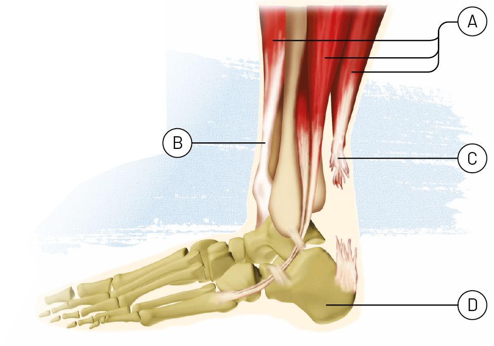 Ilustração. Parte da perna e pé de uma pessoa com os ossos, ligamentos, tendões e músculos desenhados. Na perna, de três estruturas em vermelho alongadas e terminando em estruturas de cor branca, linha de chamada para: A. Da estrutura branca que conecta estrutura em vermelho da perna e estrutura em cinza do pé na parte da frente, linha de chamada para B. Na parte de trás, estrutura branca rompida que se encontra ao final de uma estrutura vermelha, linha de chamada para C. De uma estrutura cinza na parte de trás do pé contendo parte da estrutura branca rompida, linha de chamada para D.