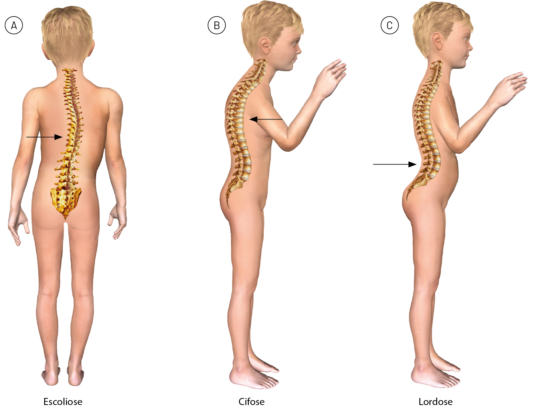 Esquema A. Escoliose. Criança branca sem roupa, de costas. Destaque para a coluna vertebral, que tem um desvio no centro para a direita. Esquema B. Cifose. Mesma criança de perfil, com o braço direito levantado na altura do rosto. Há curvatura na coluna vertebral na região entre o ombro e o antebraço. Esquema C. Lordose. Mesma criança de perfil, com o braço direito levantado na altura do rosto. A coluna vertebral tem uma inclinação para a frente, na região lombar.