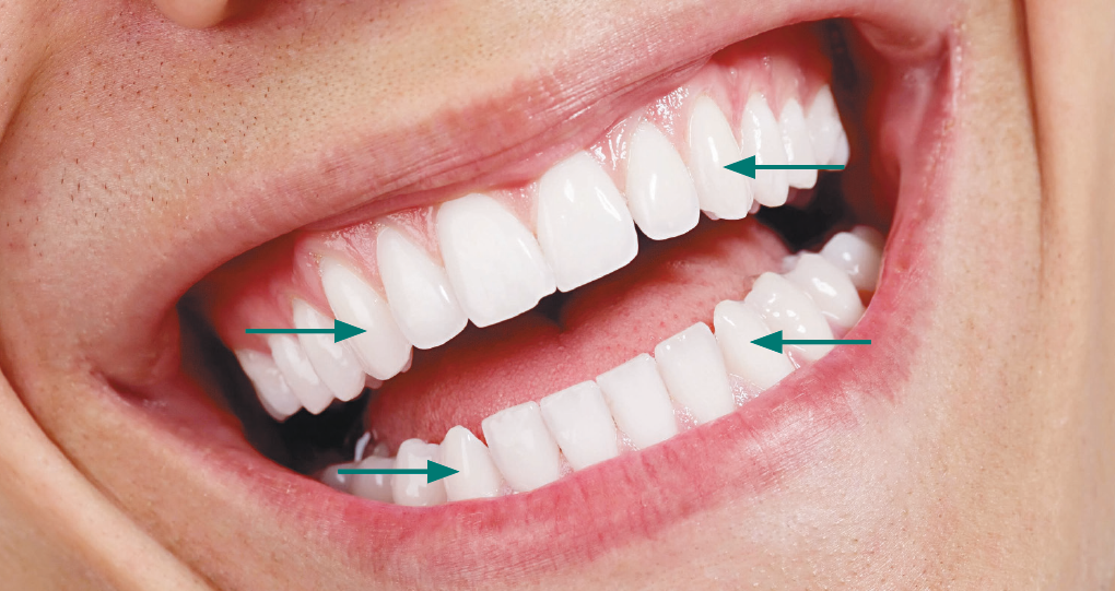 Fotografia. Sorriso de uma pessoa branca, evidenciando os dentes. Há setas indicando quatro dentes, todos eles contíguos aos incisivos: um na arcada superior à direita, um na arcada superior à esquerda, um na arcada inferior à direita e um na arcada inferior à esquerda.