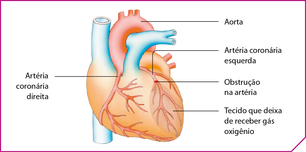 Esquema. Desenho de um coração. Na parte de cima, um tubo de grande diâmetro, a aorta, que sai no coração e ramifica sobre o músculo cardíaco em artérias coronárias direita e esquerda. A artéria coronária esquerda se ramifica, e em uma parte dela há um círculo vermelho: obstrução na artéria. Abaixo da obstrução: tecido que deixa de receber gás oxigênio.