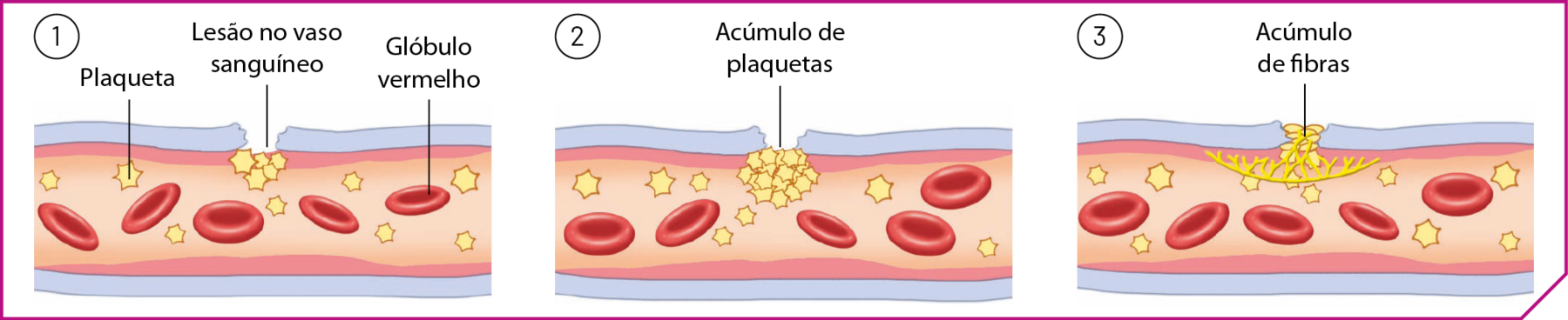 Esquema. Tubo com estruturas discoidais vermelhas representando os glóbulos vermelhos e estruturas amarelas em forma de estrelas representando as plaquetas. Em 1: há uma fissura na parte superior do tubo: Lesão no vaso sanguíneo. Em 2: há várias plaquetas acumuladas na fissura: Acúmulo de plaquetas. Em 3: Há fios em amarelo fechando a fissura: Acúmulo de fibras.