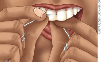 IMAGEM: o fio dental sendo passando por entre os dentes superiores da frente de uma boca, com o auxílio dos dedos das mãos. FIM DA IMAGEM.