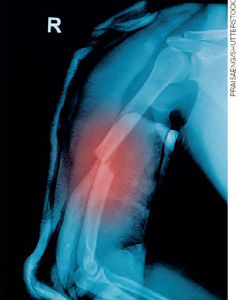 IMAGEM: radiografia de um braço humano, mostrando a área lesionada onde o osso se partiu. FIM DA IMAGEM.