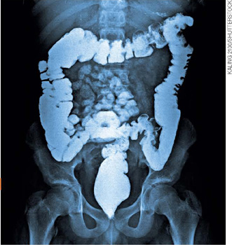 IMAGEM: radiografia de uma pessoa, mostrando o intestino grosso. FIM DA IMAGEM.
