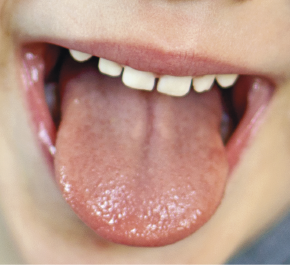 Imagem: Fotografia. Destaque para a boca de uma criança com a língua para fora. Fim da imagem.