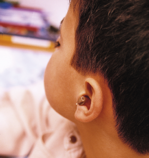 Imagem: Fotografia. Destaque de orelha de um menino com aparelho auditivo que fica internamente na ore-lha interna.  Fim da imagem.