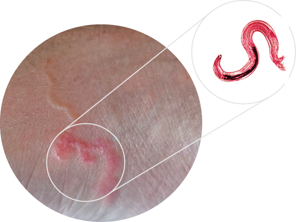 Imagem: Fotografia. Destaque de um pé com marcas vermelhas circulares. Ao lado, destaque de uma ilustração de um bicho-geográfico em formato de S. Fim da imagem.