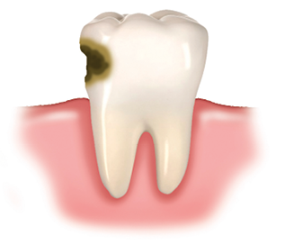 Imagem: Ilustração. Destaque de um dente com a lateral esquerda com mancha preta de cárie. Fim da imagem.