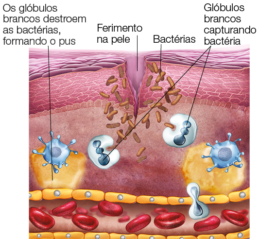 Imagem: Esquema. Ilustração de corrente de glóbulos vermelhos cercados por glóbulos brancos. Acima, uma rachadura sobre estrutura indicando ferimento na pele. Por esse machucado destaca-se algumas capsulas indicando bactérias. Glóbulos brancos soltam pequenas esferas capturando bactérias e formando pus como defesa. Fim da imagem.