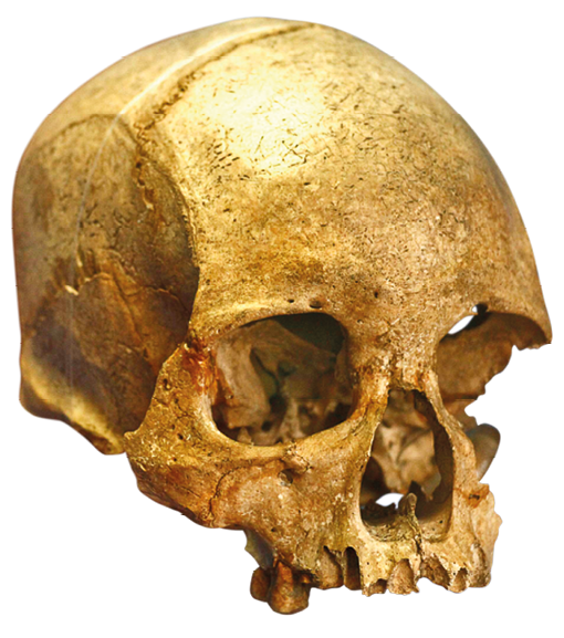 Imagem: Fotografia. Crânio que apresenta as cavidades dos olhos e nariz, arcada com um dente e região da cabeça grande e com aspecto liso. Fim da imagem.