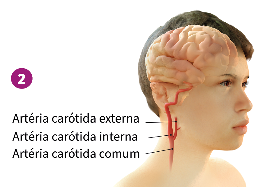 Fotomontagem. Saindo da parte inferior do cérebro de um menino há veias avermelhadas na lateral do rosto e do pescoço; ao lado, as informações: 
Artéria carótida externa. 
Artéria carótida interna. 
Artéria carótida comum.