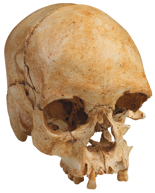 Fotografia. Crânio humano, arredondado, com uma rachadura horizontal. Tem a cavidade dos olhos grande a arredondada. A cavidade do nariz é triangular. Tem alguns dentes.