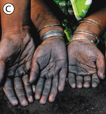 Fotografia C. Destaque para palmas de três mãos com sujeira preta. Duas delas, à direita, estão com  braceletes prateados.