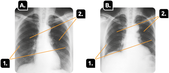 Fotografias. Marcada com a letra A, uma radiografia da caixa torácica de uma pessoa. Indicadas pelo número 1, as costelas, estruturas curvas e achatadas. Indicados com o número 2, os pulmões na parte interna. Marcado com a letra B, uma radiografia da caixa torácica de uma pessoa. Indicadas pelo número 1, as costelas aparecem acima do meio da radiografia. Indicados com o número 2, os pulmões na parte interna.