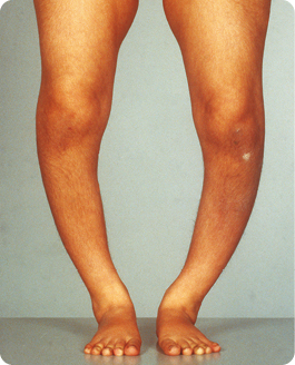 Fotografia. Pernas de uma pessoa, que a partir dos joelhos, são curvadas para fora. 