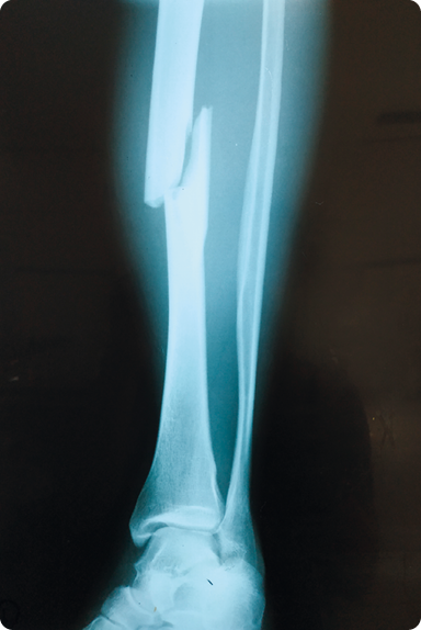 Fotografia. Uma radiografia de uma perna mostrando dois ossos compridos, com um deles quebrado ao meio. 