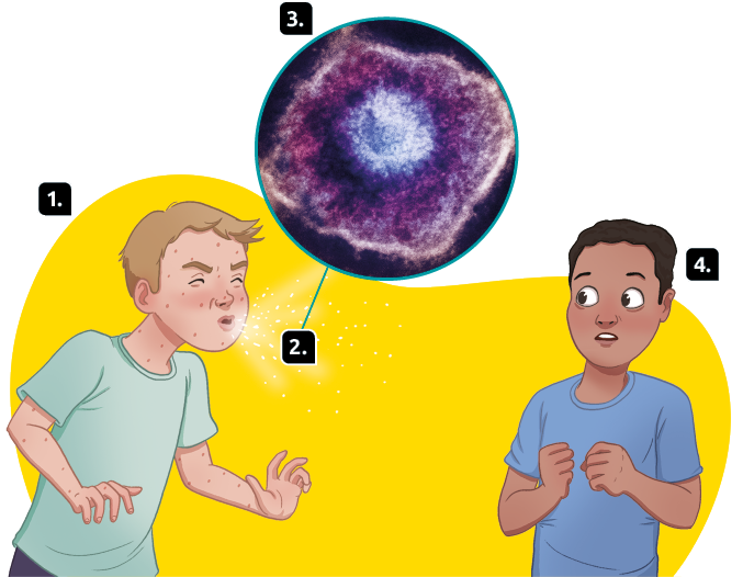 Esquema representando a transmissão de catapora. Marcado com número 1, uma ilustração de uma pessoa com manchas em toda a pele dando um espirro. Marcado com o número 2, gotículas sendo expelidas pela boca da pessoa. Marcado com o número 3, fotografia do vírus, que tem uma forma circular de cor azul no centro e entorno roxo. Marcado com o número 4, uma pessoa com uma expressão assustada olhando para a pessoa que está espirrando.