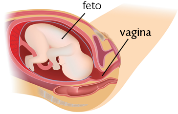 Ilustração de vista lateral em corte da barriga de uma mulher. No interior do útero, o feto está posicionado de cabeça para baixo, com a cabeça voltada para a direção da vagina, na parte inferior.