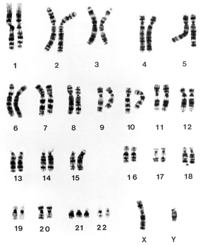 Fotografia. 22 pares de cromossomos numerados de 1 a 22, com exceção daquele indicado pelo número 21, que apresenta três cromossomos. Também há os cromossomos X e Y, totalizando 47 cromossomos. Os cromossomos têm tamanhos diferentes e formato de filamentos espessos, com alguns deles curvos. Eles estão pareados e organizados em ordem decrescente de tamanho. O cromossomo X é bem maior em relação ao cromossomo Y.