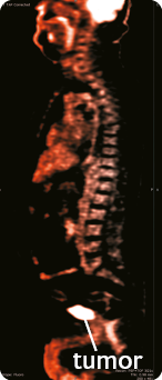 Fotografia de uma imagem obtida por tomografia. Sobre um fundo escuro há a figura de uma pessoa de perfil, da cabeça até a região pélvica, com os ossos e outras estruturas em coloração avermelhada. Na região pélvica há uma forma arredondada de coloração clara, com a seguinte indicação: tumor.